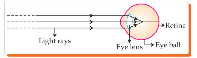 Ray diagram showing a defect of vision where image forms in front of the retina