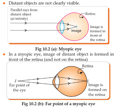 Ray diagrams showing myopic eye in back seat, front seat, and with concave lens correction