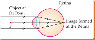 Ray diagrams showing image formation in a myopic eye and its correction using a concave lens